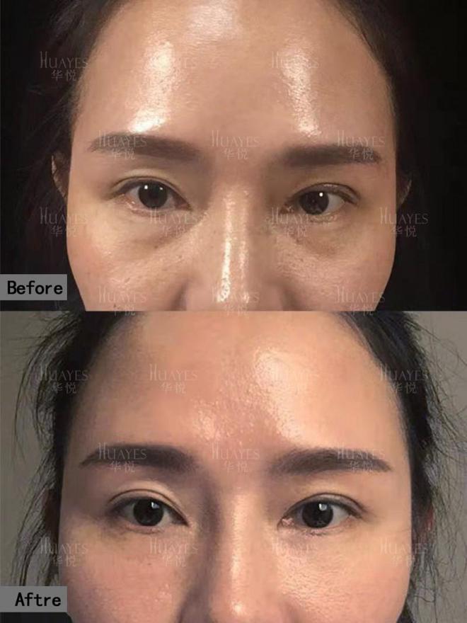部青春光彩一键重启眼部青春魅力凯发K8华悦白孝梅院长：重塑眼(图2)